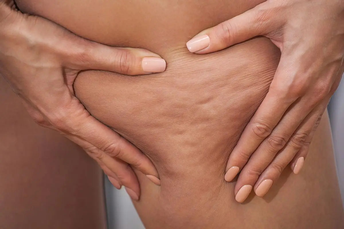 Cellulite: sintomi, cause e rimedi