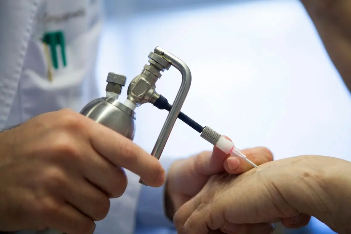 Crioterapia con azoto liquido: cos’è, a cosa serve e come si esegue