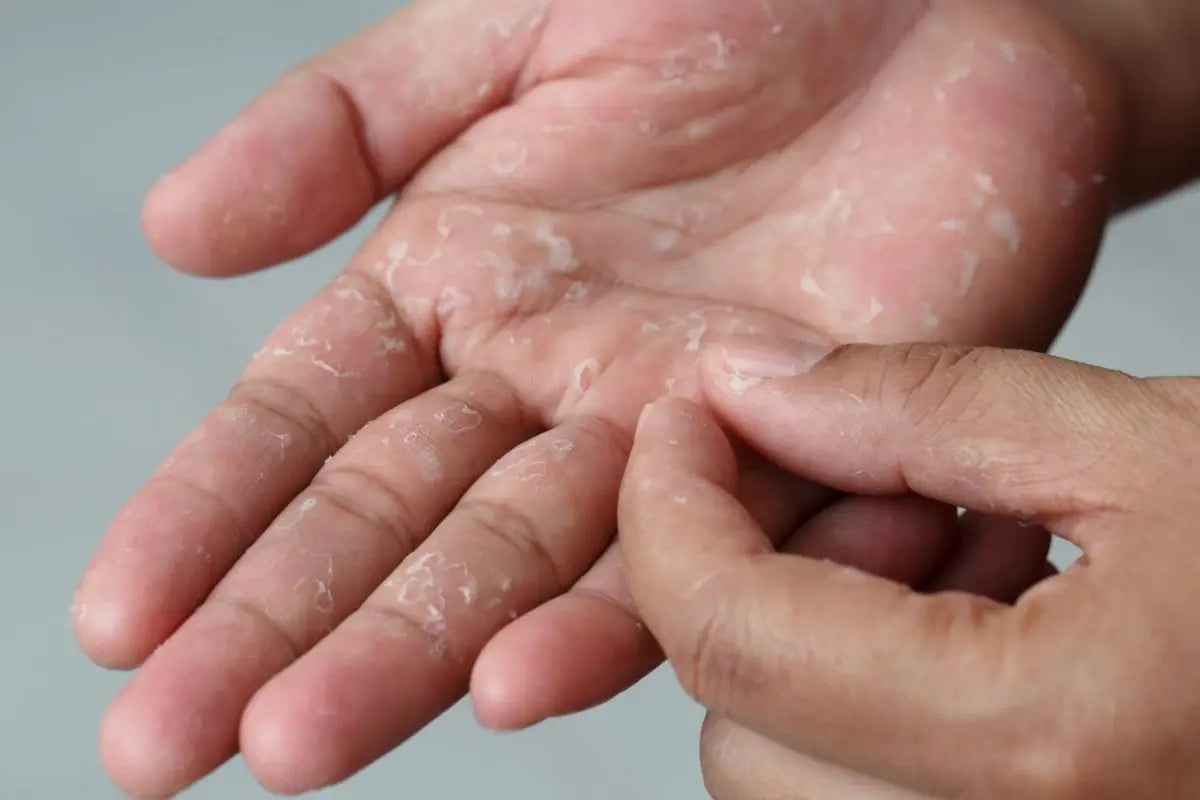 Disidrosi: sintomi, cause e trattamenti Farmae - Para-farmacia Online di cosmesi, para-farmaci... Disidrosi: sintomi, cause e trattamenti Farmae - Para-farmacia Online di cosmesi, para-farmaci...