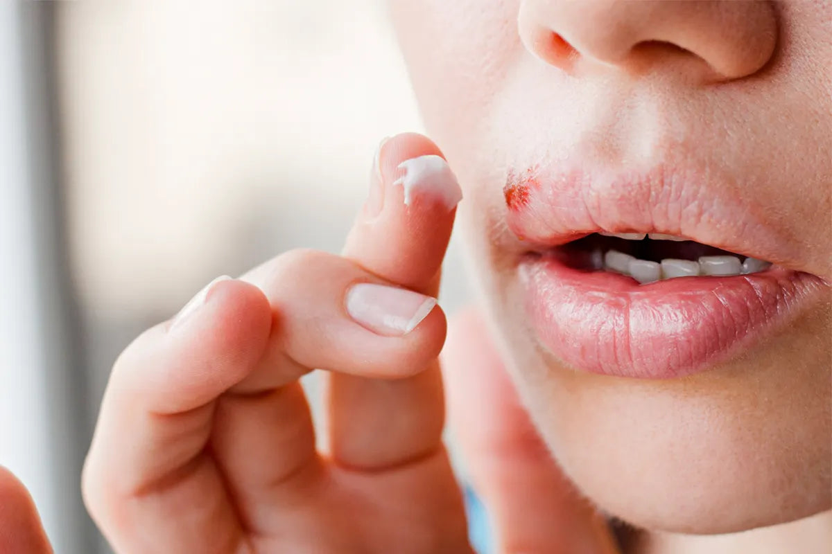 Herpes labiale, 4 prodotti per farlo sparire!