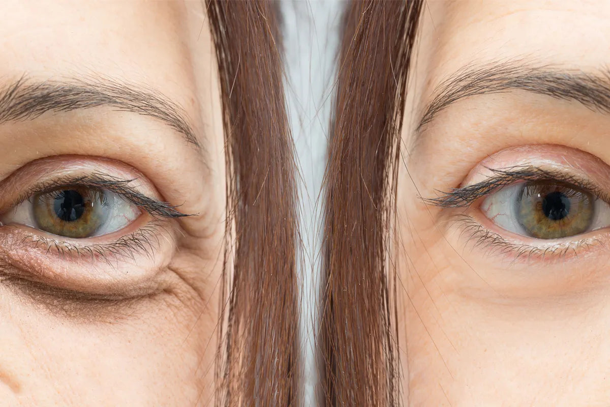 Che differenza c’è tra le borse agli occhi e le occhiaie?