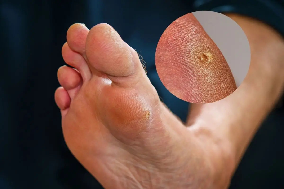 Occhio di pernice: sintomi e trattamenti