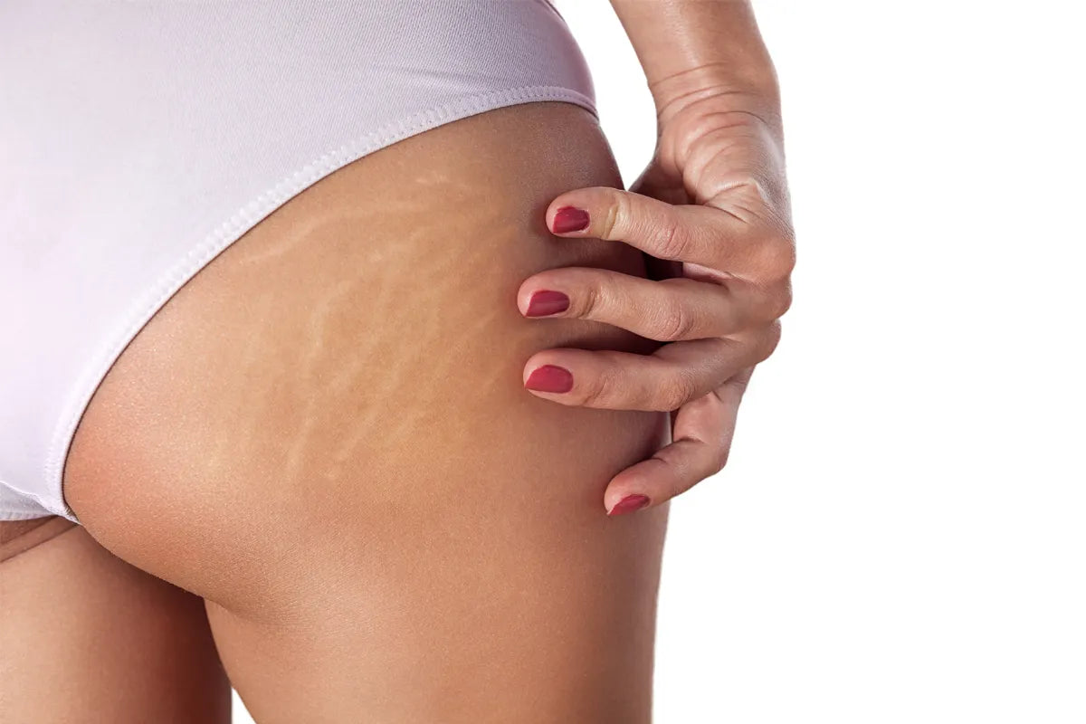 Come eliminare le smagliature?
