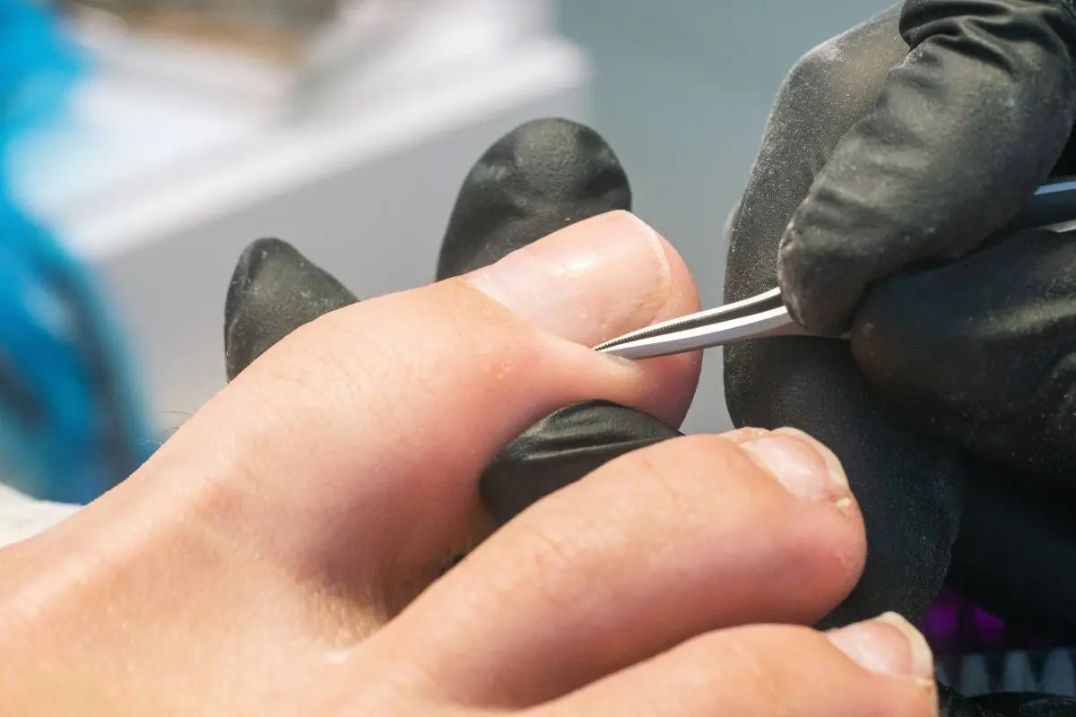 Unghia incarnita: fattori di rischio, sintomi e terapia