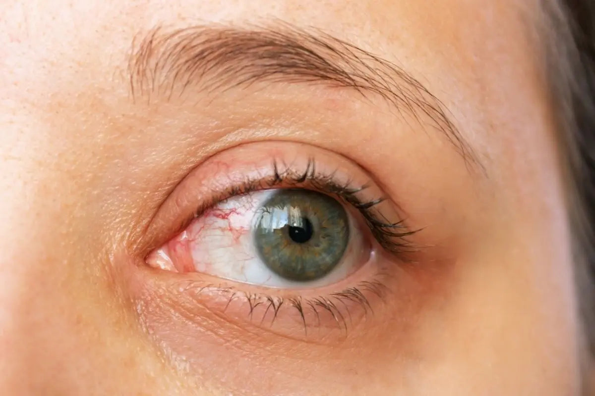 Uveite: cos’è, sintomi, cause e cure