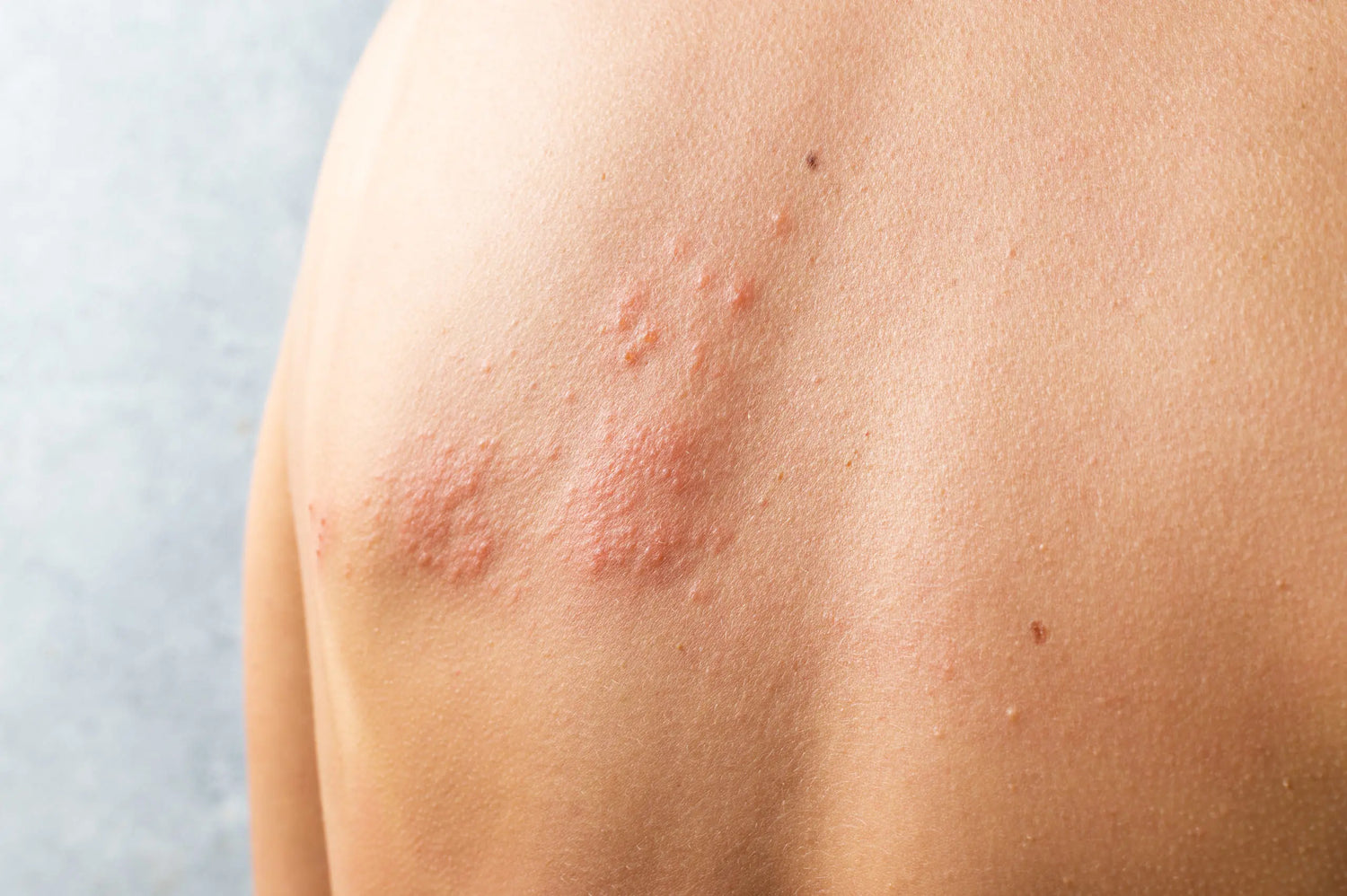 Sole amico della dermatite: i consigli per proteggersi