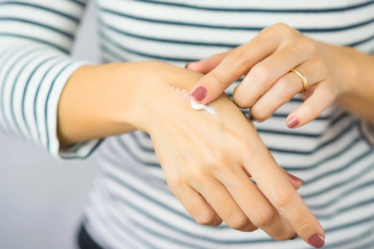 Come curare le cicatrici? I nostri consigli