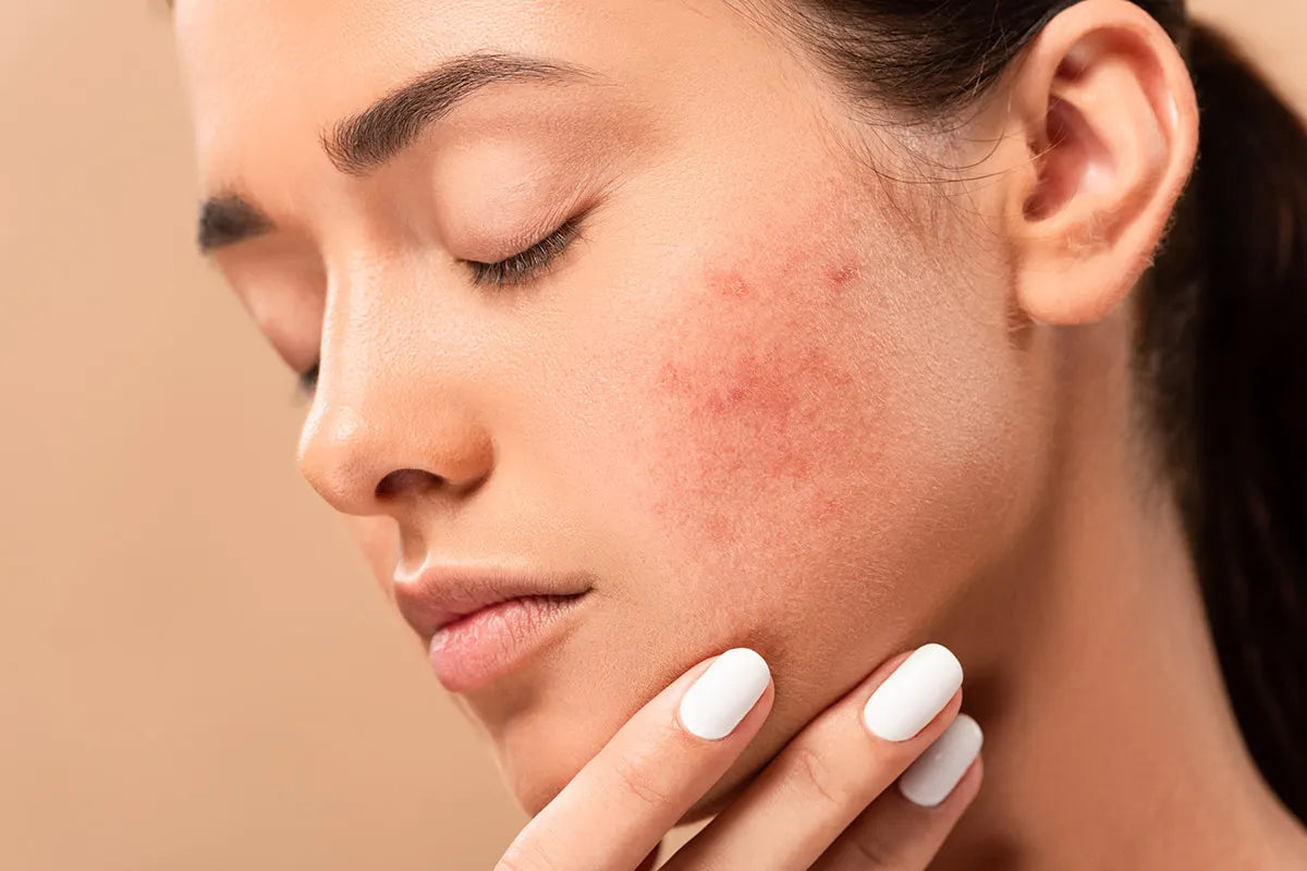 Acne, da cosa è provocata e come trattarla