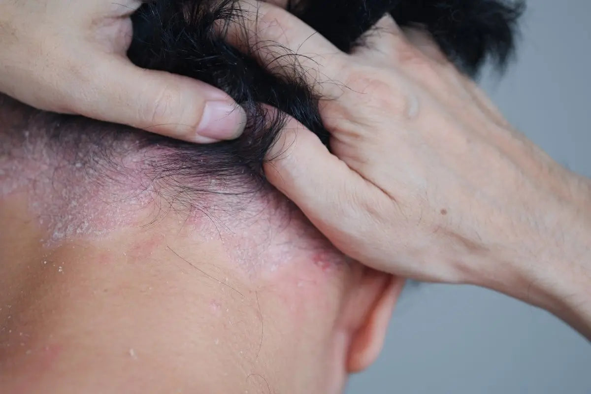 Dermatite seborroica: sintomi e terapie