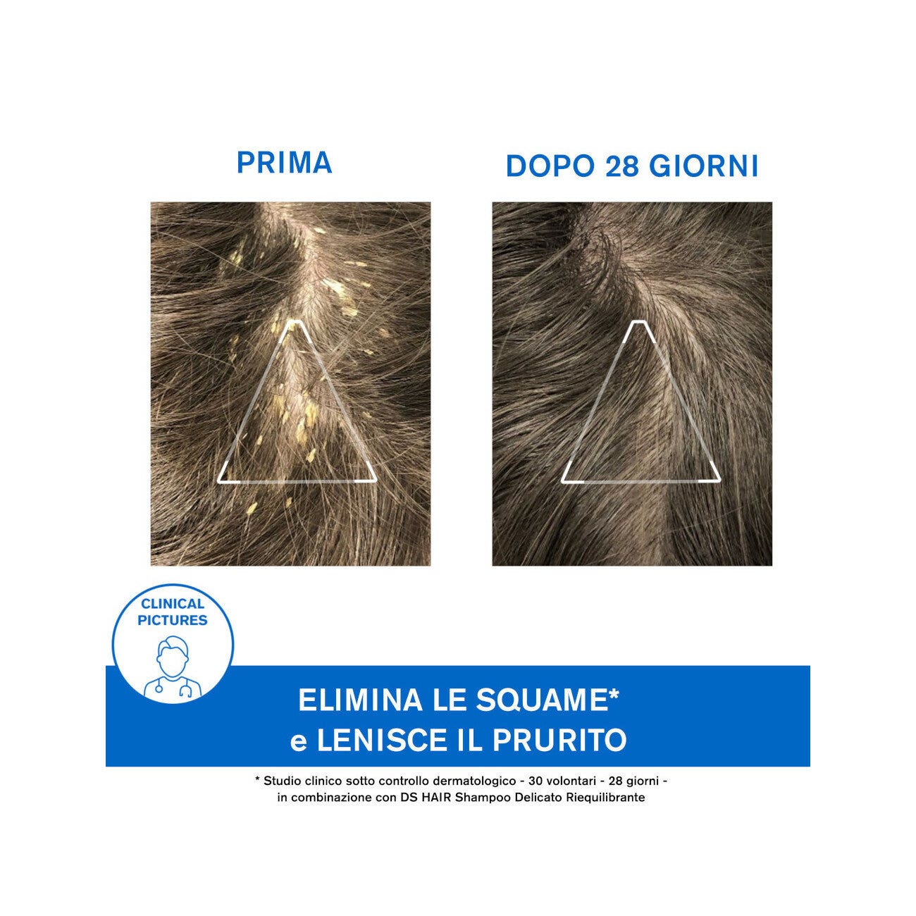 Uriage DS Hair Shampoo Trattamento Cheratoriduttore 150ml-6