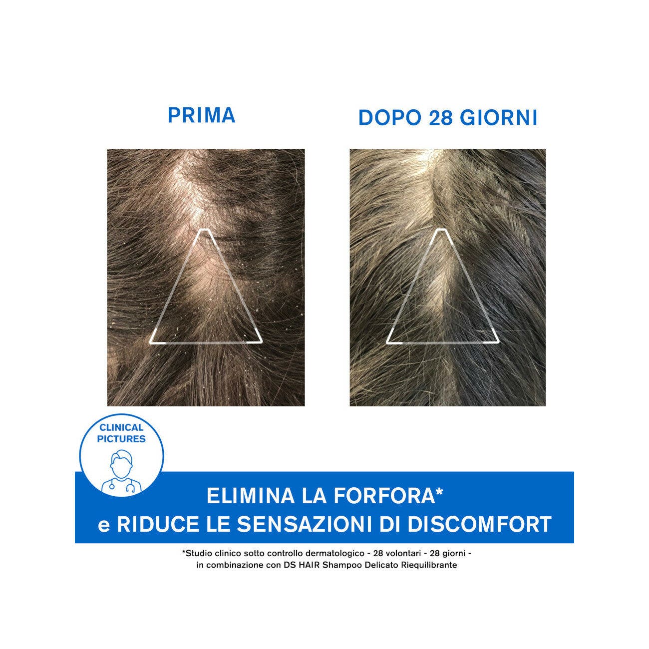 Uriage DS Hair Trattamento Antiforfora 200ml-6