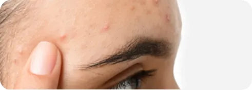 Acne