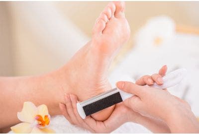 Rimedi per calli ai piedi