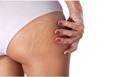 Come eliminare le smagliature?