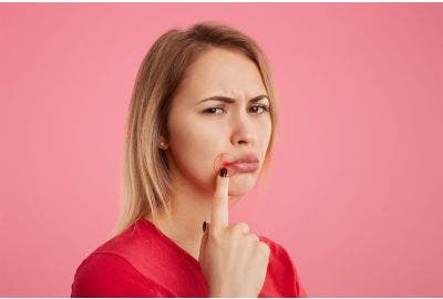 Herpes labiale: perché viene e come curarlo?