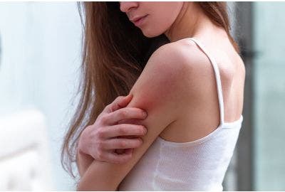 Tenere sotto controllo i disturbi della dermatite atopica: ecco come calmare il prurito