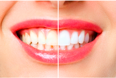 Denti macchiati? Ecco come ripristinare il bianco naturale