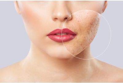 Combattere l’acne: consigli e prodotti per curare la pelle