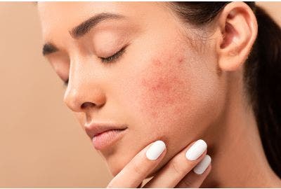 Acne, da cosa è provocata e come trattarla