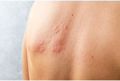 Sole amico della dermatite: i consigli per proteggersi