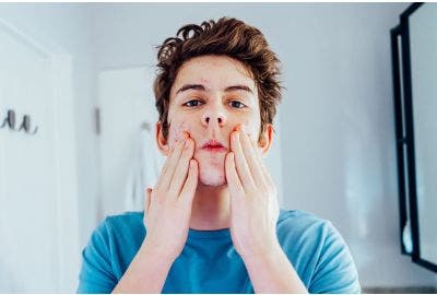 3 consigli per detergere la pelle acneica