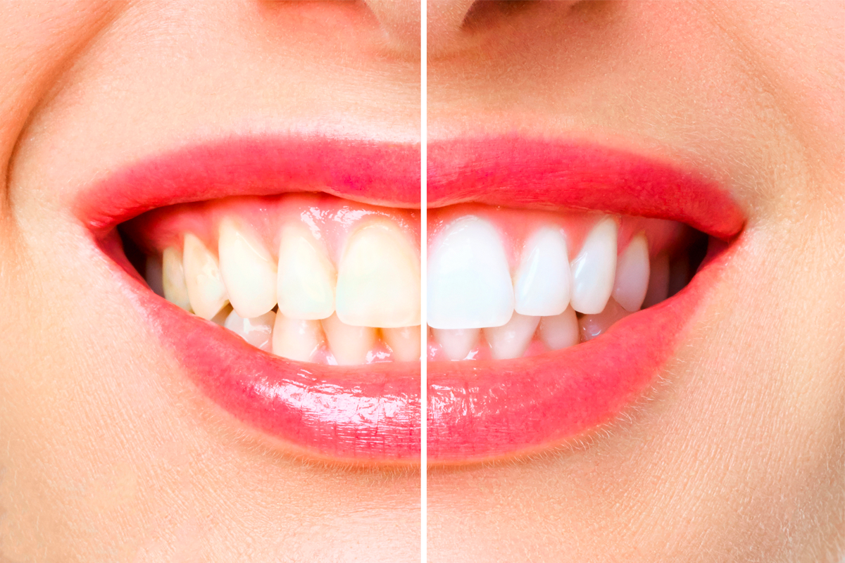 Denti macchiati? Ecco come ripristinare il bianco naturale