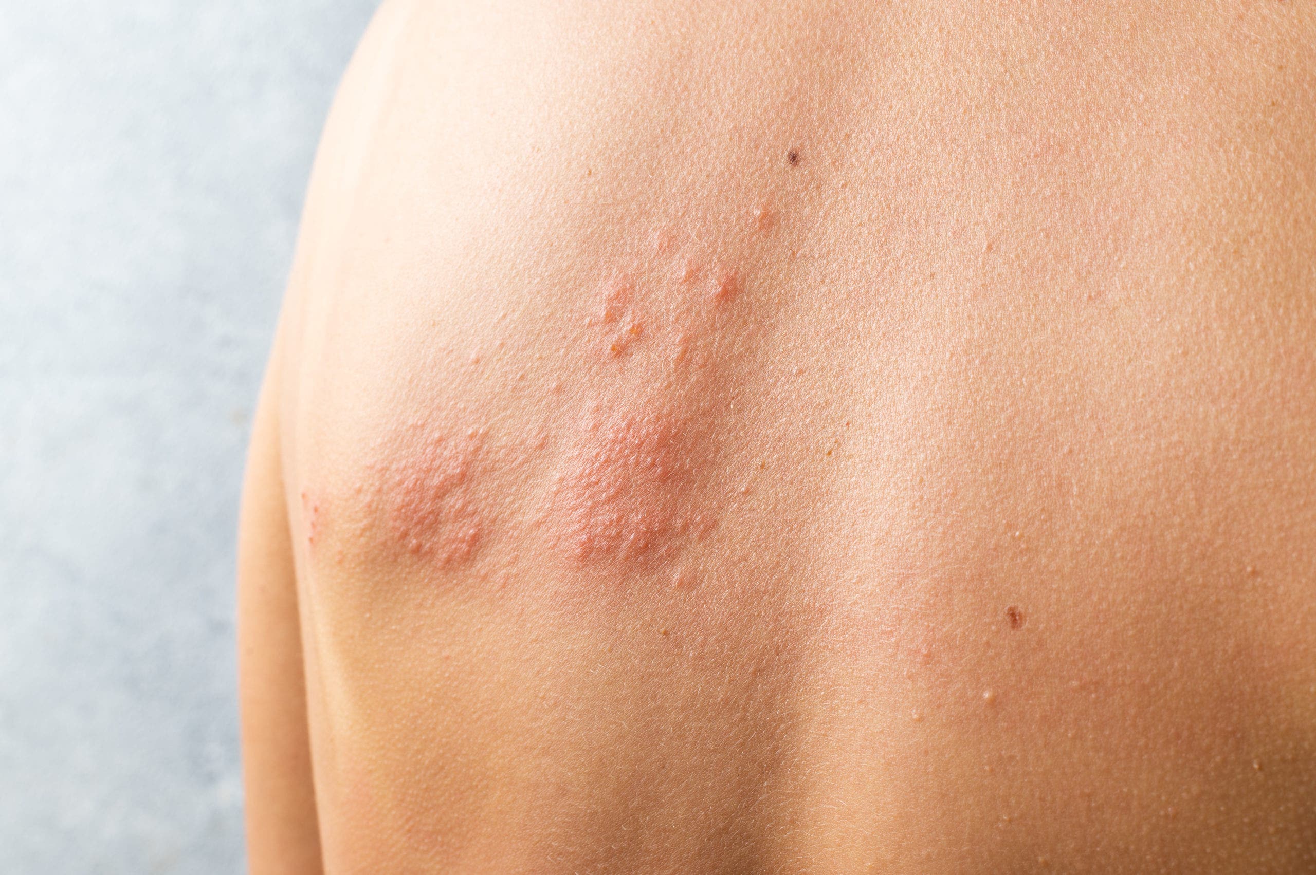 Sole amico della dermatite: i consigli per proteggersi