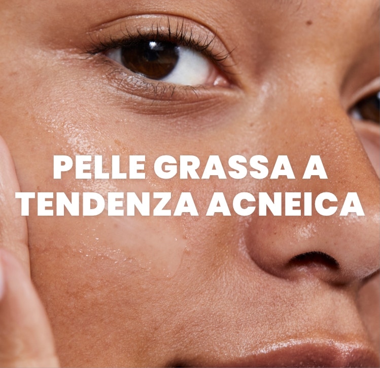 Pelle grassa a tendenza acneica
